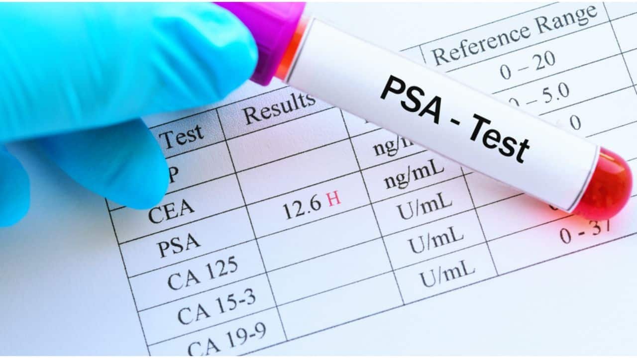 The PSA Prostate-Specific Antigen